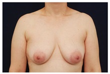 Breast Lift Before Photo by Michael Law, MD; Raleigh, NC - Case 33528