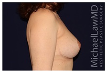 Breast Lift After Photo by Michael Law, MD; Raleigh, NC - Case 33528