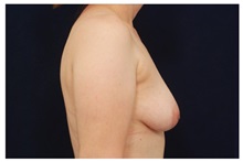 Breast Lift Before Photo by Michael Law, MD; Raleigh, NC - Case 33528