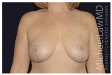 Breast Lift After Photo by Michael Law, MD; Raleigh, NC - Case 33529