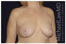 Breast Lift After Photo by Michael Law, MD; Raleigh, NC - Case 33529