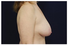 Breast Lift Before Photo by Michael Law, MD; Raleigh, NC - Case 33529
