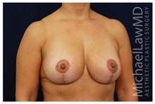 Breast Lift After Photo by Michael Law, MD; Raleigh, NC - Case 33530