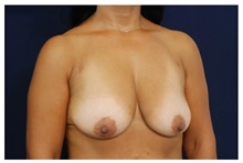 Breast Lift Before Photo by Michael Law, MD; Raleigh, NC - Case 33530