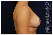 Breast Lift After Photo by Michael Law, MD; Raleigh, NC - Case 33530