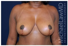 Breast Lift After Photo by Michael Law, MD; Raleigh, NC - Case 33531