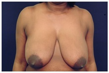 Breast Lift Before Photo by Michael Law, MD; Raleigh, NC - Case 33531