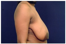 Breast Lift Before Photo by Michael Law, MD; Raleigh, NC - Case 33531