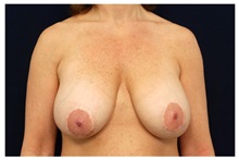 Breast Lift Before Photo by Michael Law, MD; Raleigh, NC - Case 33532
