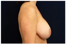 Breast Lift Before Photo by Michael Law, MD; Raleigh, NC - Case 33532