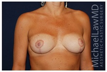 Breast Lift After Photo by Michael Law, MD; Raleigh, NC - Case 33533