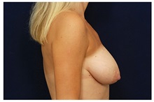 Breast Lift Before Photo by Michael Law, MD; Raleigh, NC - Case 33533