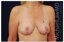 Breast Lift After Photo by Michael Law, MD; Raleigh, NC - Case 33534