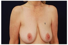 Breast Lift Before Photo by Michael Law, MD; Raleigh, NC - Case 33534