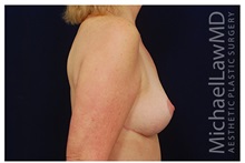 Breast Lift After Photo by Michael Law, MD; Raleigh, NC - Case 33534