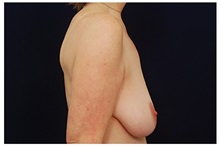 Breast Lift Before Photo by Michael Law, MD; Raleigh, NC - Case 33534