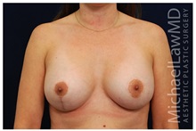 Breast Lift After Photo by Michael Law, MD; Raleigh, NC - Case 33535