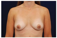 Breast Lift Before Photo by Michael Law, MD; Raleigh, NC - Case 33535