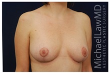 Breast Lift After Photo by Michael Law, MD; Raleigh, NC - Case 33536