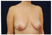Breast Lift Before Photo by Michael Law, MD; Raleigh, NC - Case 33536