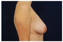 Breast Lift Before Photo by Michael Law, MD; Raleigh, NC - Case 33536