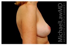 Breast Lift After Photo by Michael Law, MD; Raleigh, NC - Case 33537