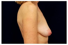 Breast Lift Before Photo by Michael Law, MD; Raleigh, NC - Case 33537