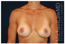 Breast Lift After Photo by Michael Law, MD; Raleigh, NC - Case 33538