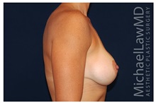 Breast Lift After Photo by Michael Law, MD; Raleigh, NC - Case 33538