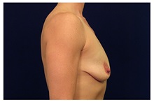 Breast Lift Before Photo by Michael Law, MD; Raleigh, NC - Case 33538