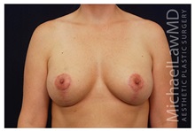Breast Lift After Photo by Michael Law, MD; Raleigh, NC - Case 33539
