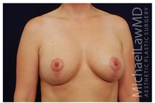 Breast Lift After Photo by Michael Law, MD; Raleigh, NC - Case 33539