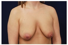 Breast Lift Before Photo by Michael Law, MD; Raleigh, NC - Case 33539