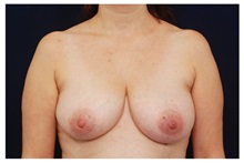 Breast Lift Before Photo by Michael Law, MD; Raleigh, NC - Case 33540