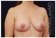 Breast Lift After Photo by Michael Law, MD; Raleigh, NC - Case 33540