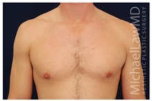 Male Breast Reduction After Photo by Michael Law, MD; Raleigh, NC - Case 33583