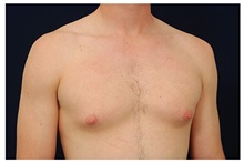 Male Breast Reduction Before Photo by Michael Law, MD; Raleigh, NC - Case 33583