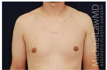 Male Breast Reduction After Photo by Michael Law, MD; Raleigh, NC - Case 33584
