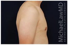 Male Breast Reduction After Photo by Michael Law, MD; Raleigh, NC - Case 33584