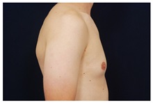 Male Breast Reduction Before Photo by Michael Law, MD; Raleigh, NC - Case 33584