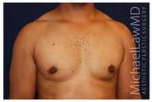 Male Breast Reduction After Photo by Michael Law, MD; Raleigh, NC - Case 33585