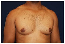 Male Breast Reduction Before Photo by Michael Law, MD; Raleigh, NC - Case 33585