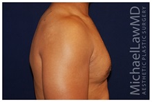 Male Breast Reduction After Photo by Michael Law, MD; Raleigh, NC - Case 33585