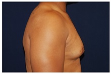 Male Breast Reduction Before Photo by Michael Law, MD; Raleigh, NC - Case 33585