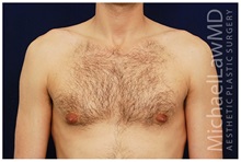 Male Breast Reduction After Photo by Michael Law, MD; Raleigh, NC - Case 33586