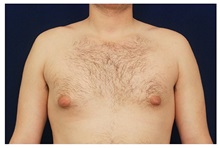 Male Breast Reduction Before Photo by Michael Law, MD; Raleigh, NC - Case 33586