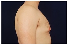 Male Breast Reduction Before Photo by Michael Law, MD; Raleigh, NC - Case 33586