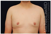 Male Breast Reduction After Photo by Michael Law, MD; Raleigh, NC - Case 33587