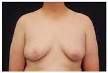 Male Breast Reduction Before Photo by Michael Law, MD; Raleigh, NC - Case 33587