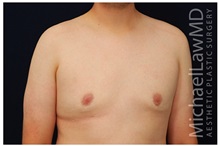 Male Breast Reduction After Photo by Michael Law, MD; Raleigh, NC - Case 33587
